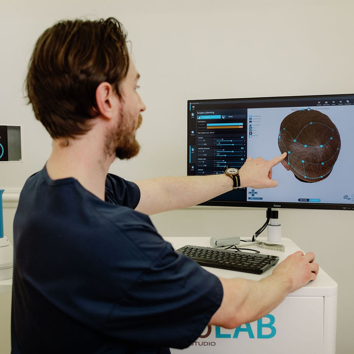 Doctor reviewing a hair transplant treatment plan with detailed scalp mapping